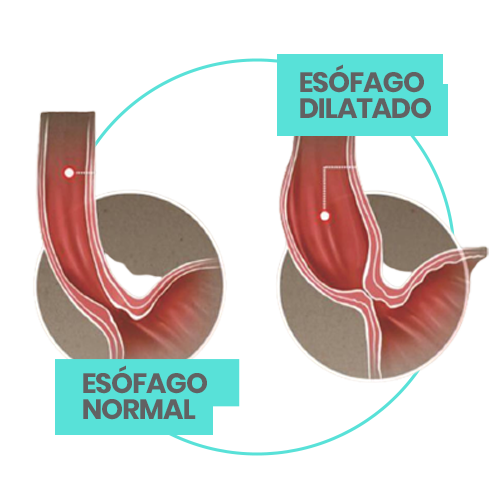 acalasia, doctor, cirujano, victor sanchez, ciudad juarez